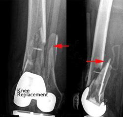 Distal femur fracture near an artificial knee joint