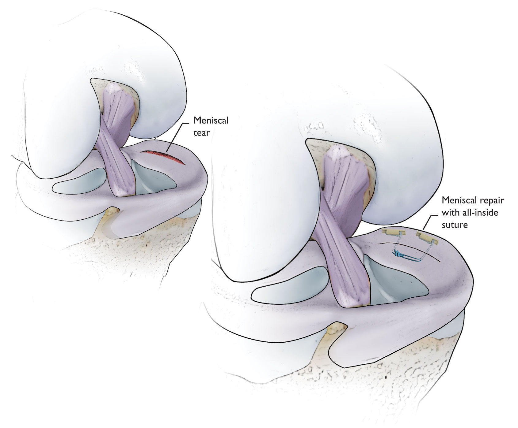 Illustration Showing All-Inside Meniscus Repair