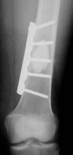 plate and screw fixation of distal femur for MBD