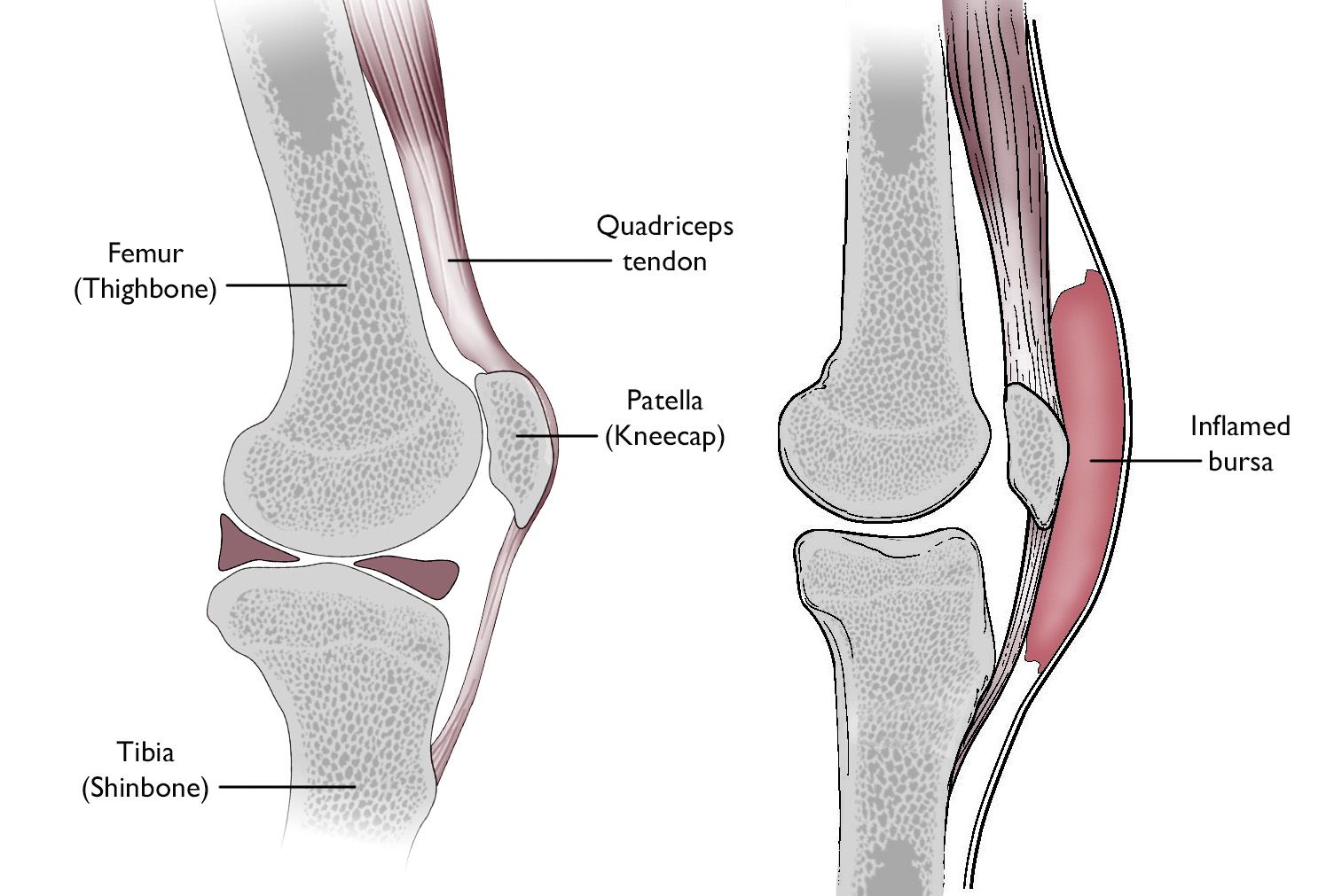 Normal knee anatomy including the bursa involved in prepatellar bursitis