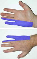 Compresion del nervio cubital en el codo sindrome del tunel cubital Ulnar Nerve Entrapment at the Elbow Cubital Tunnel Syndrome OrthoInfo AAOS