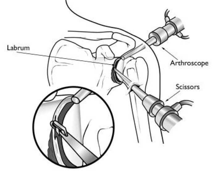 shoulder arthroscopy