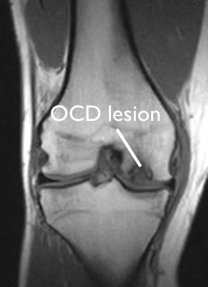 MRI of OCD lesion in knee
