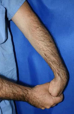 Ulnar Nerve Entrapment at the Elbow (Cubital Tunnel Syndrome) - OrthoInfo -  AAOS