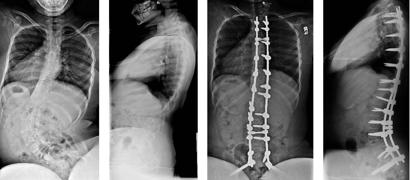 x-rays of large spinal curve and fusion