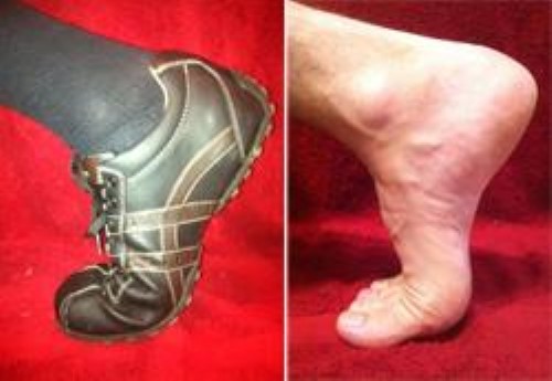 Turf Toe Treatment Brace  Sprained Big Toe Injury Relief