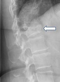 X-ray showing vertebral narrowing