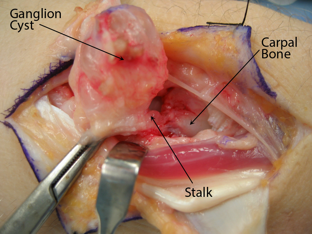 Excision of ganglion cyst