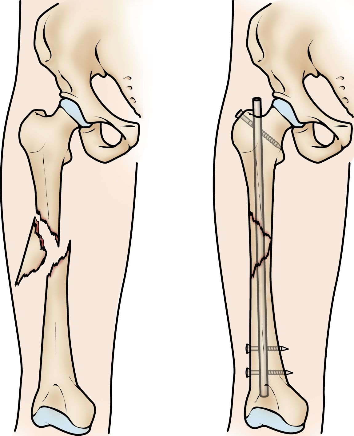 péndulo superávit inyectar Fracturas de la diáfisis femoral (ruptura del hueso del muslo) (Femur Shaft  Fractures (Broken Thighbone)) - OrthoInfo - AAOS