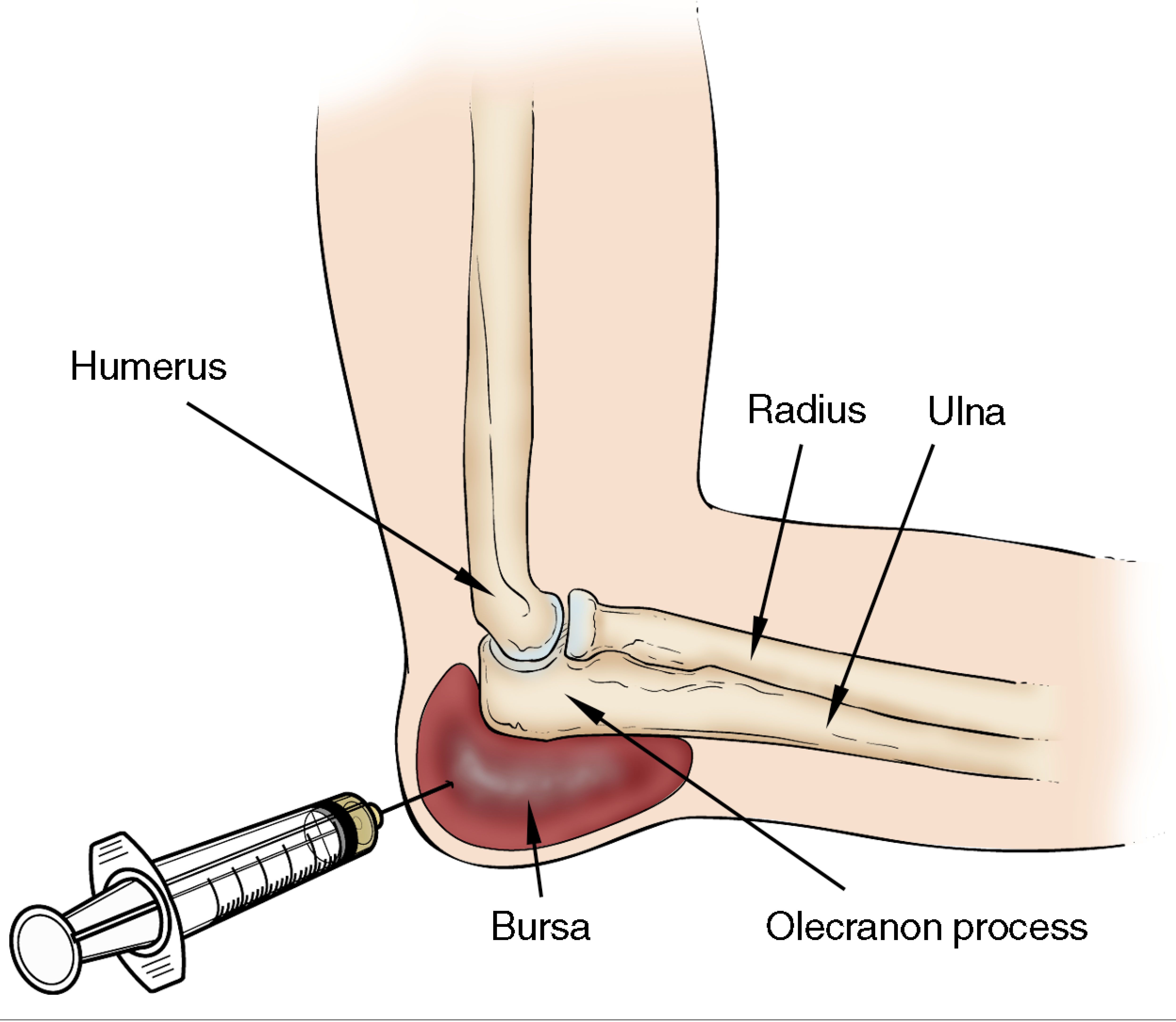 Elbow aspiration