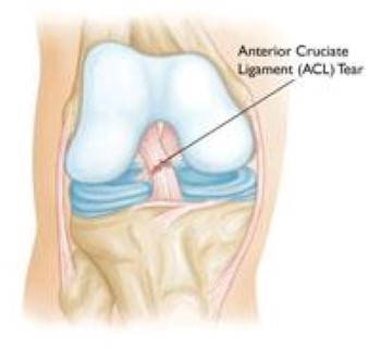 ACL tear