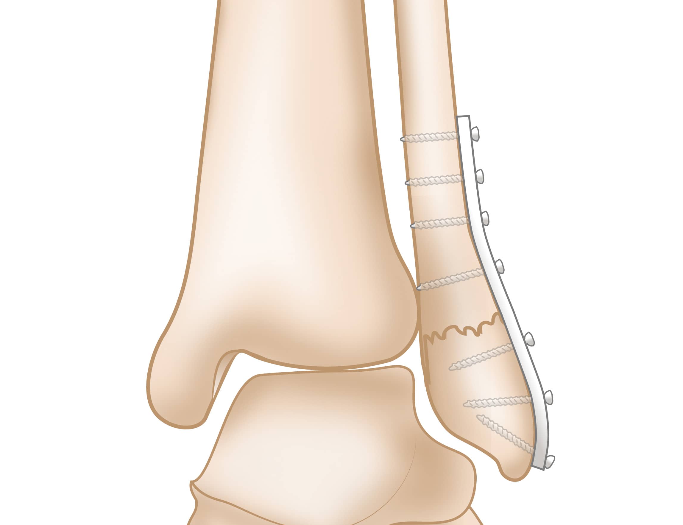 medial malleolus