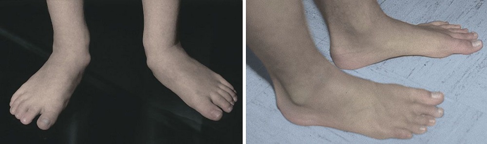 Flexible Pes Planovalgus (Flexible Flatfoot) - Pediatrics - Orthobullets