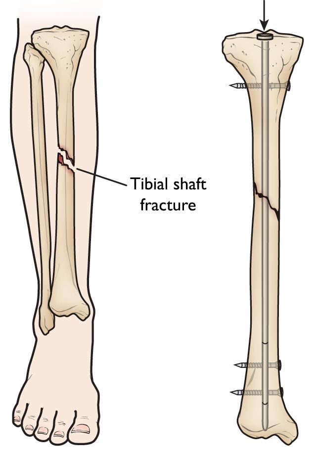 Tibia and fibula, shaft