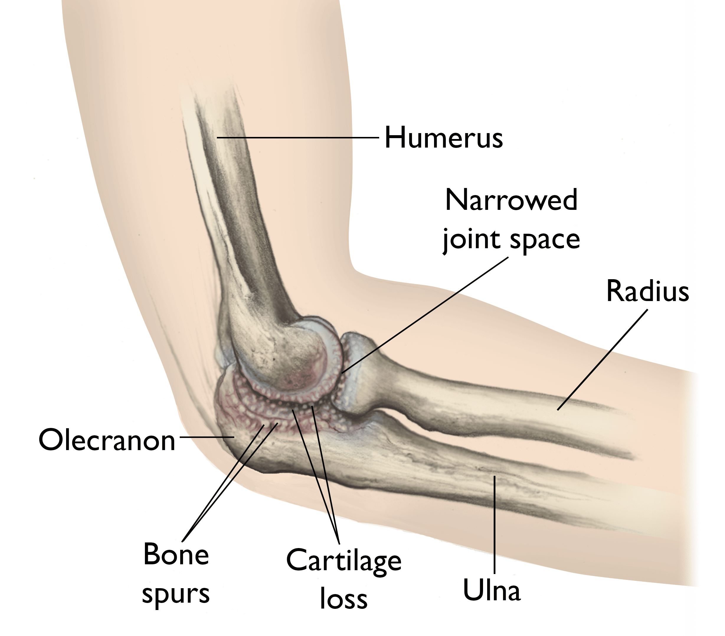 Osteoarthritis of the Elbow - OrthoInfo - AAOS