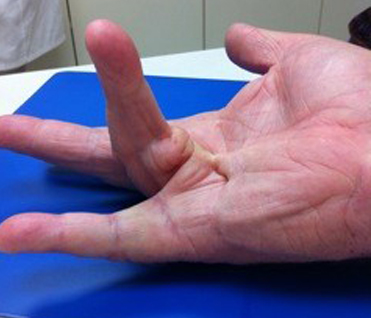 Dupuytren's contracture - Wikipedia