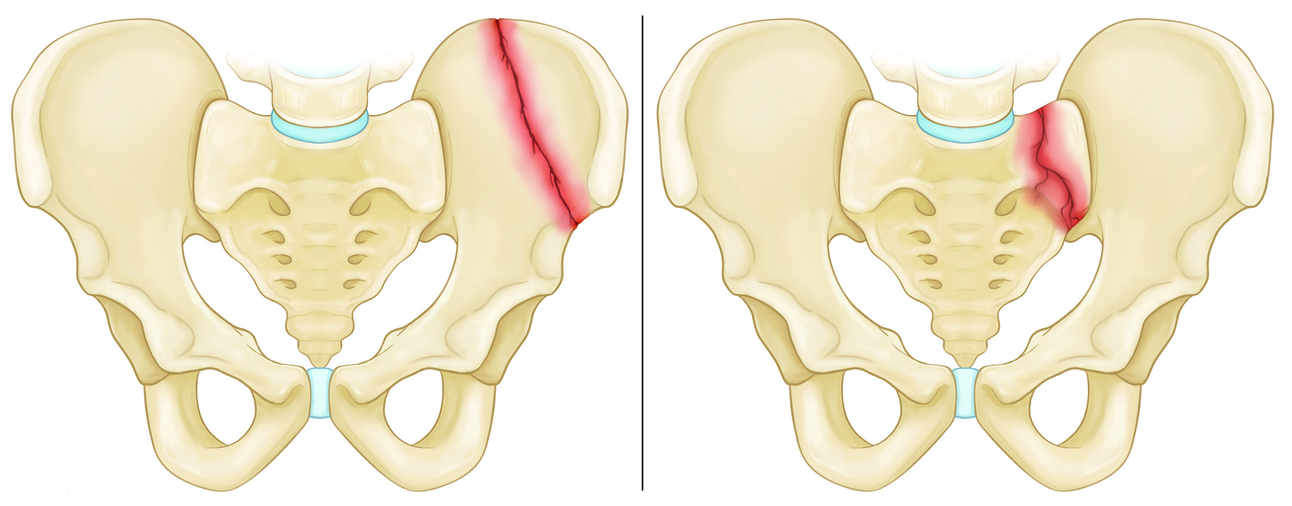 Illustrations of illiac wing and sacrum fractures