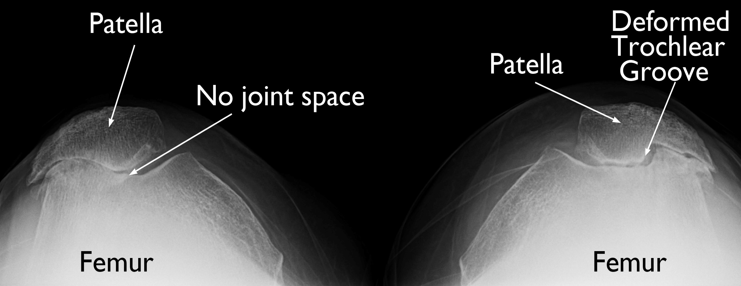 X-rays of knee dysplasia and deformed trochlear groove