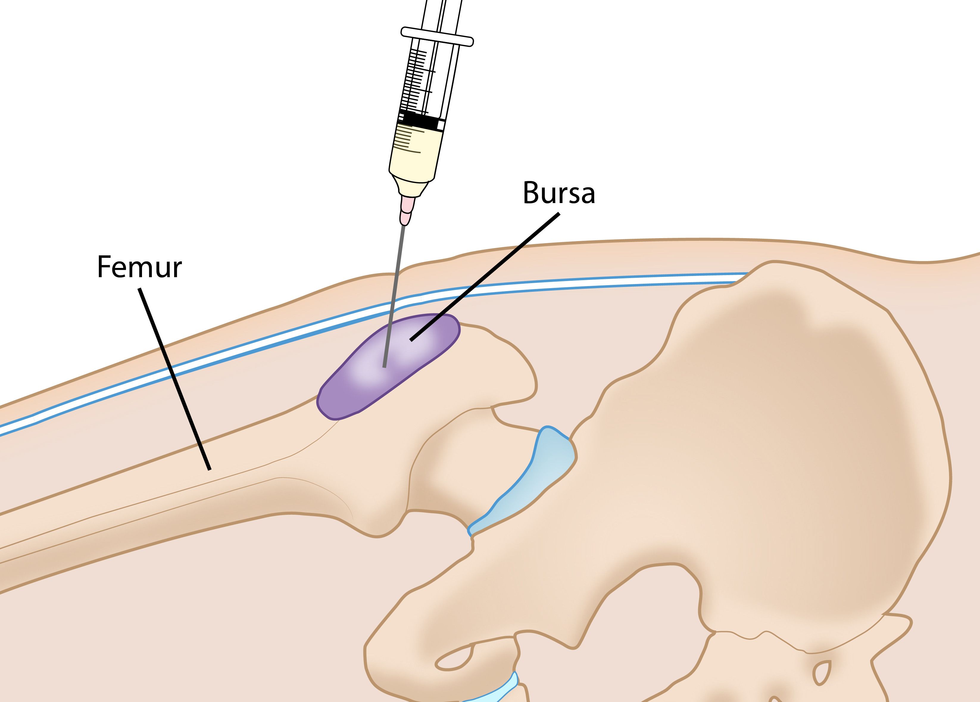 Corticosteroid injection