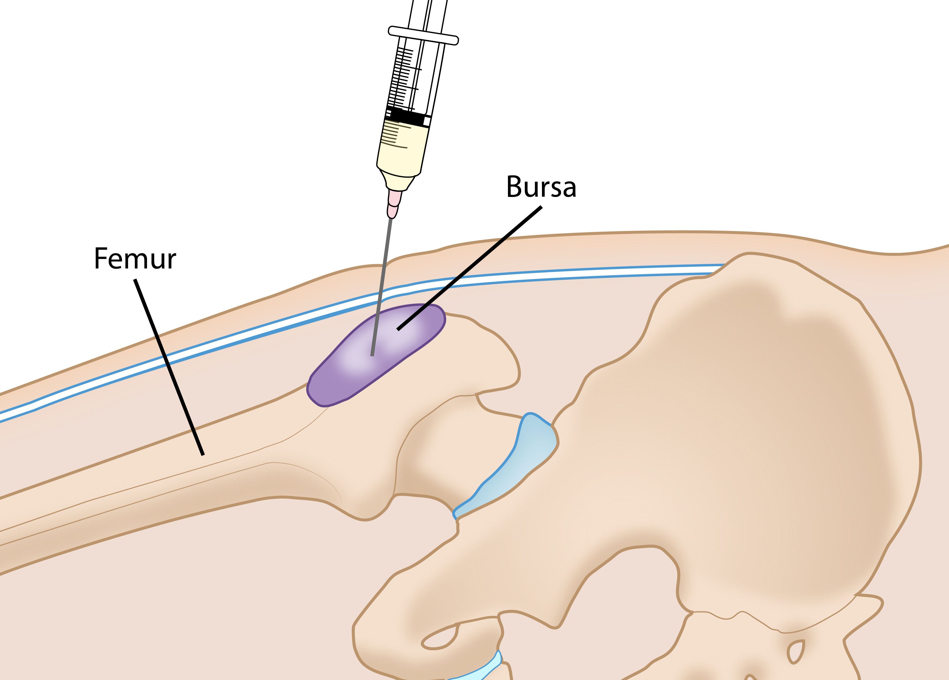 Trochanteric Bursitis, Hip Bursitis, Orthopedic Hip Specialist