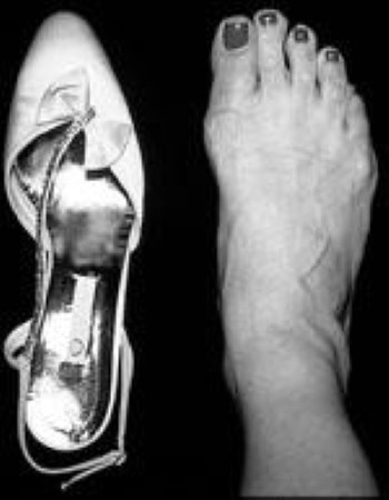 Tight Shoes and Foot Problems - OrthoInfo - AAOS