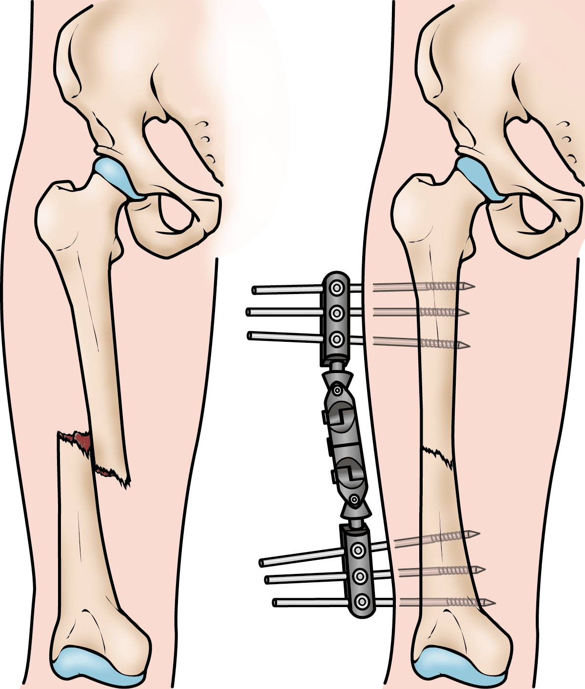 Femur (thighbone) fracture treated with external fixation