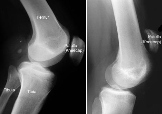 Patellar Tendinitis/Quadriceps Tendinitis - Overview - Mayo Clinic  Orthopedics & Sports Medicine