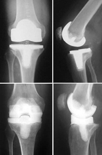 X-ray of knee replacement and antibiotic spacer