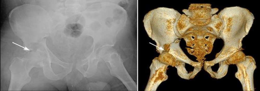 X-ray and 3-dimensional CT reconstruction of an acetabular fracture