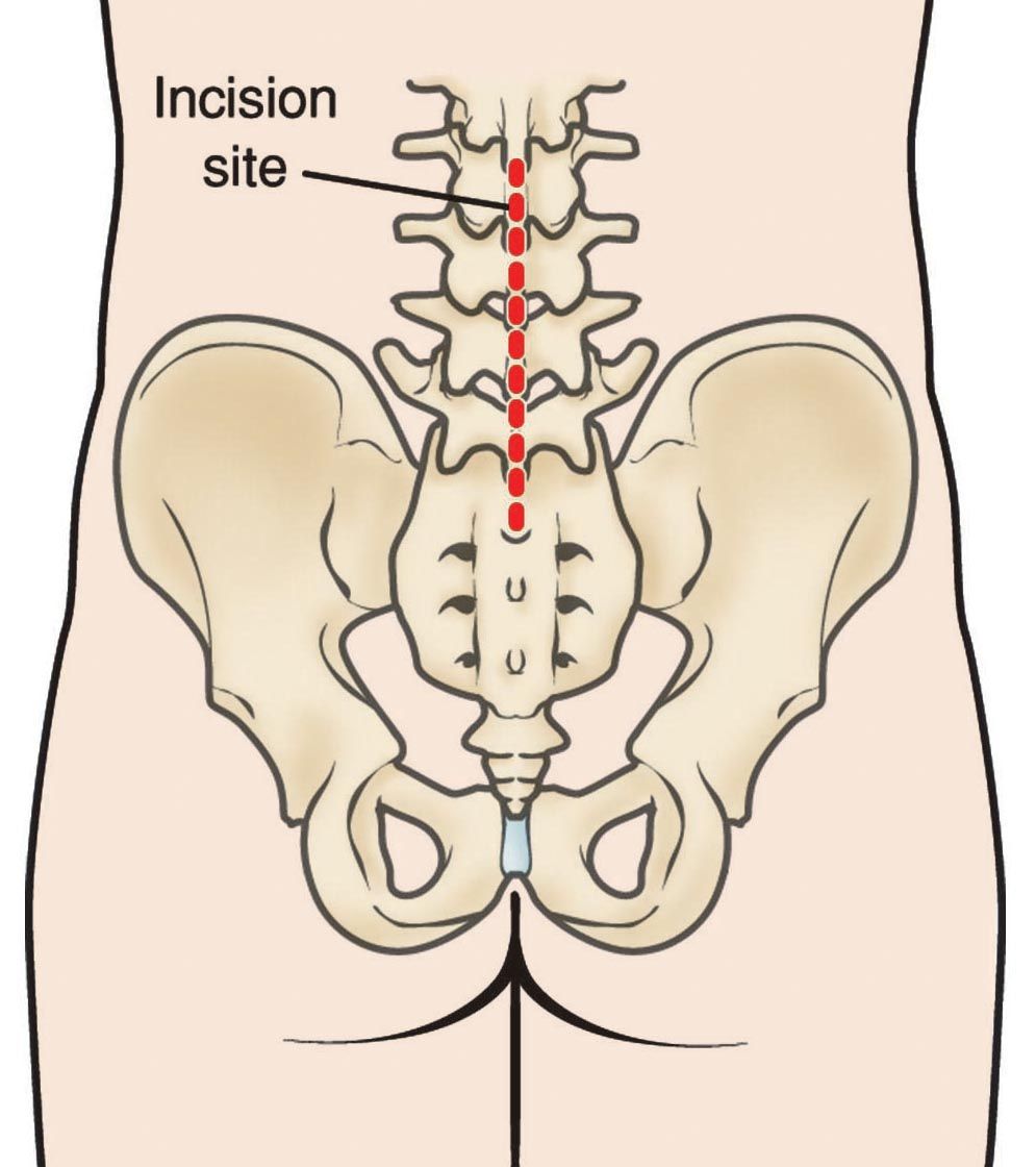 anterior lumbar fusion scar