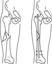 Fixation of femur with intramedullary nail