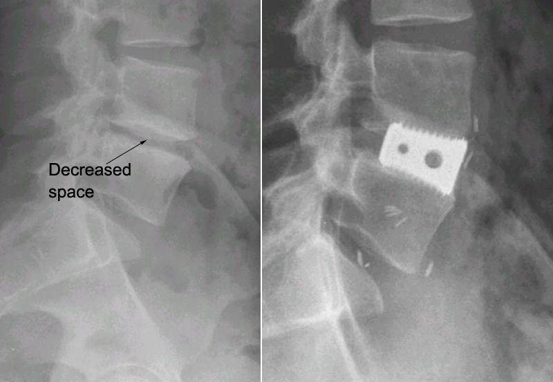 Post-Op Braces after Back Surgery, Fusion, Laminectomy