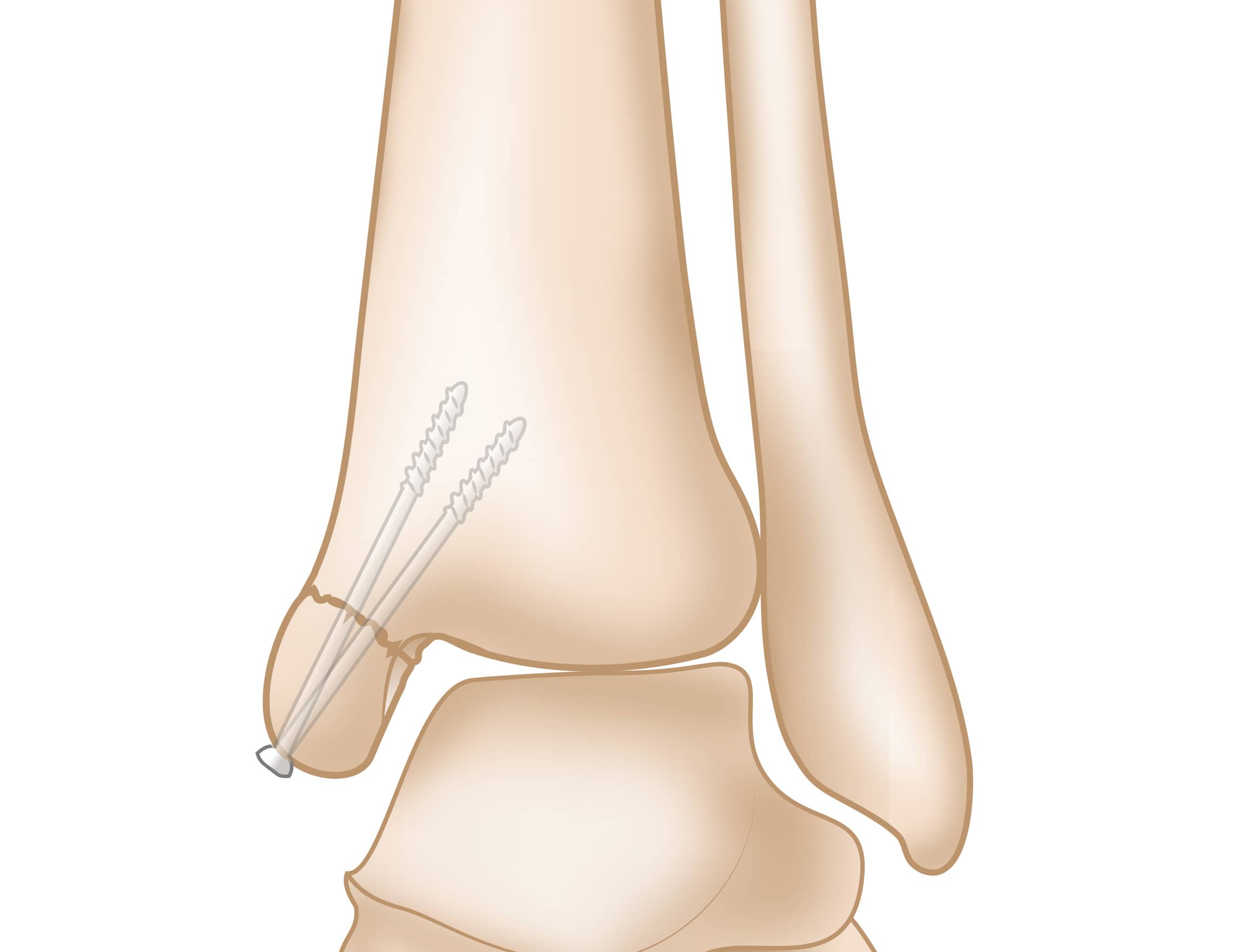 Beugel affix Openbaren Ankle Fractures (Broken Ankle) - OrthoInfo - AAOS