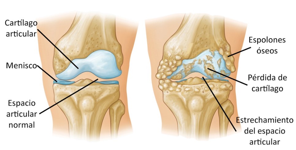 Cuándo operar la artrosis de rodilla?