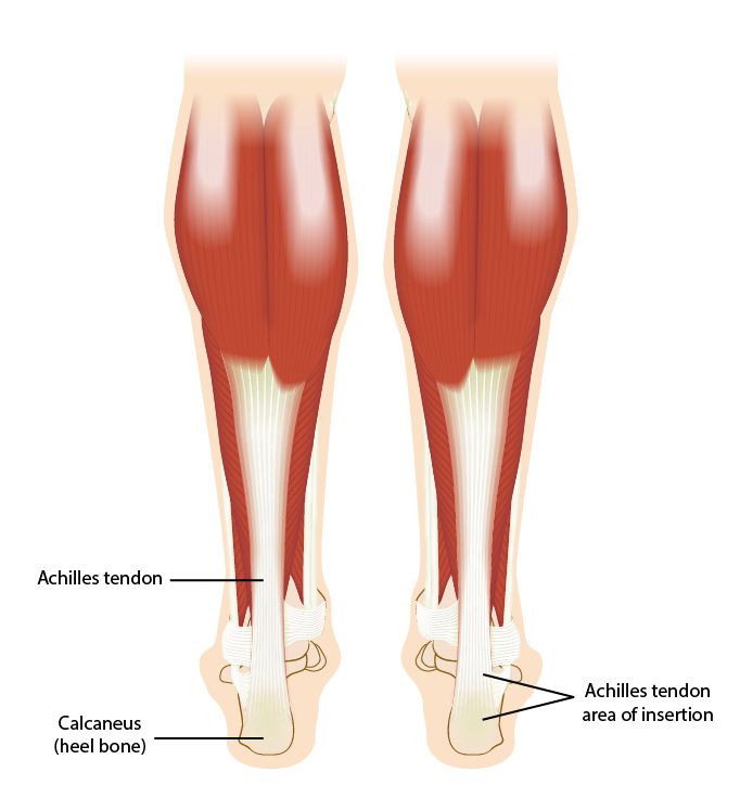 Achilles Heel Spur: Causes, Symptoms, and Treatment - CircleDNA