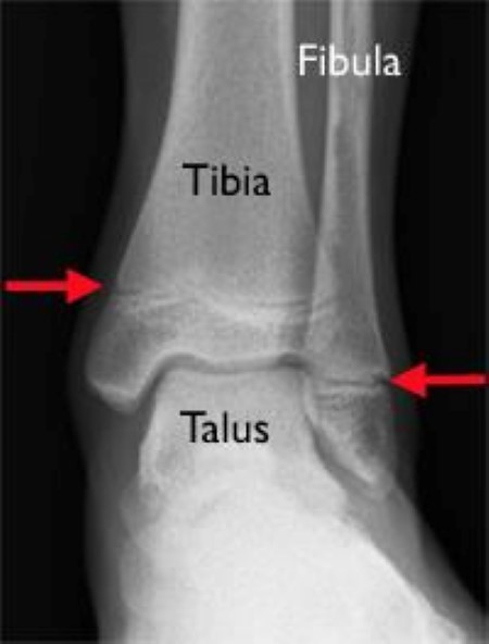 fractured ankle x ray