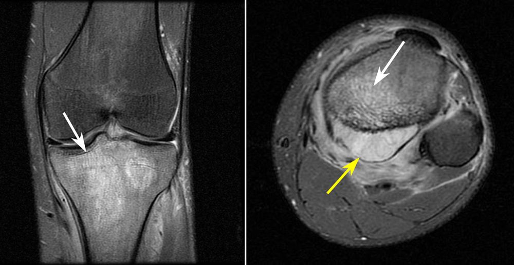 MRI scans of tumor