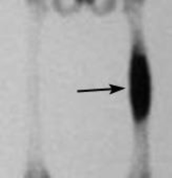 Fibrous Dysplasia - OrthoInfo - AAOS