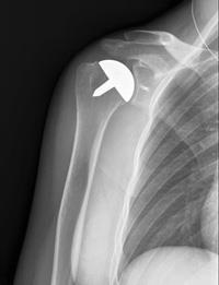 Shoulder Joint Replacement - OrthoInfo - AAOS