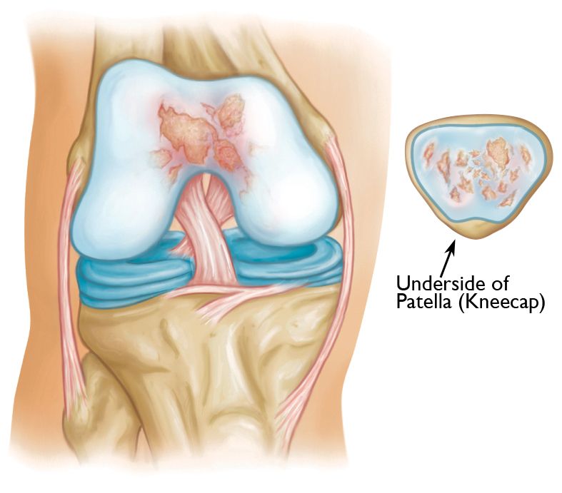 Knee cap deals disorders