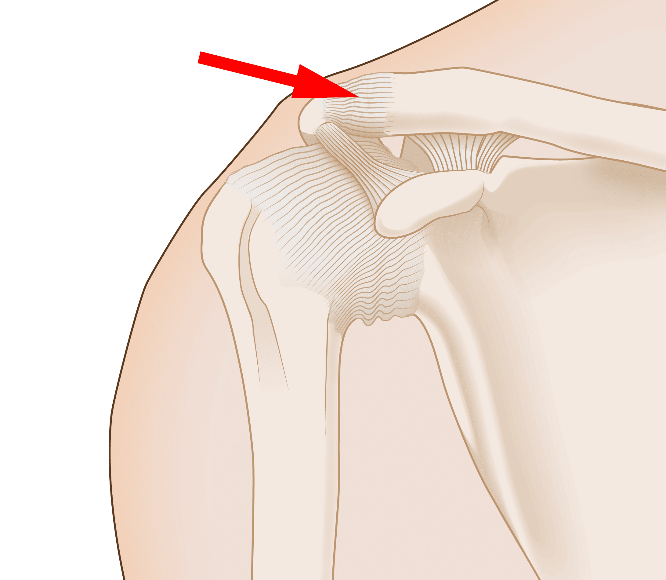 AC Joint Seperations and Injuries a Patients Guide