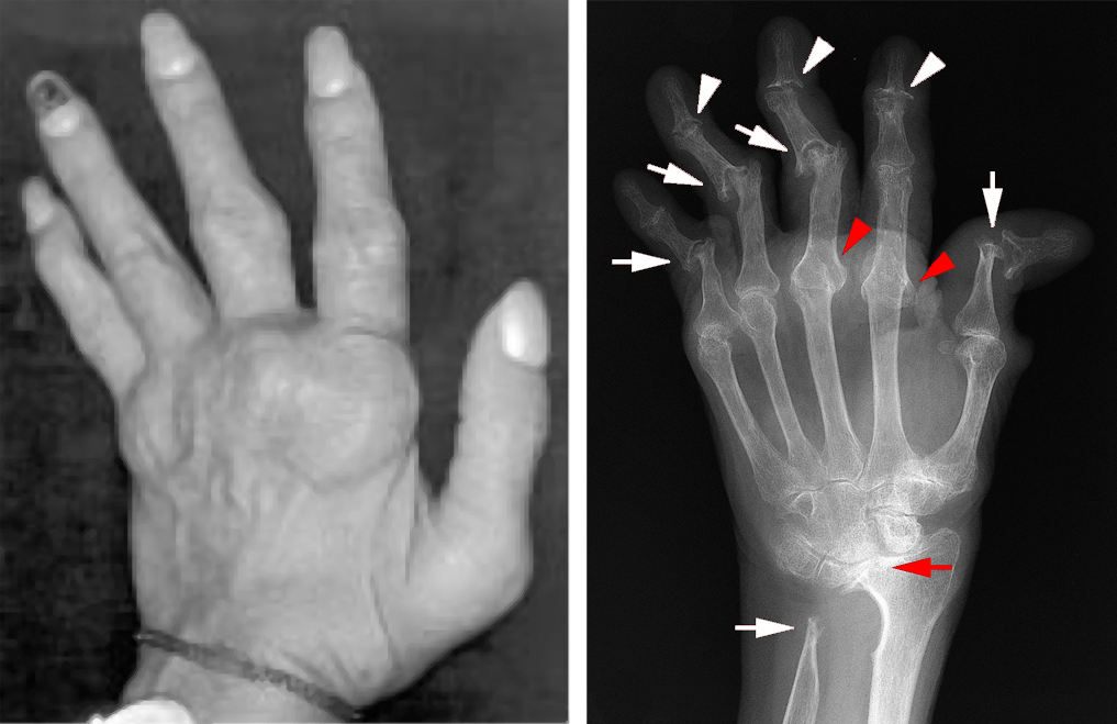 Rheumatoid Arthritis Disease Progression: Signs Rheumatoid