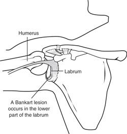 Illustration of a Bankart lesion in the labrum