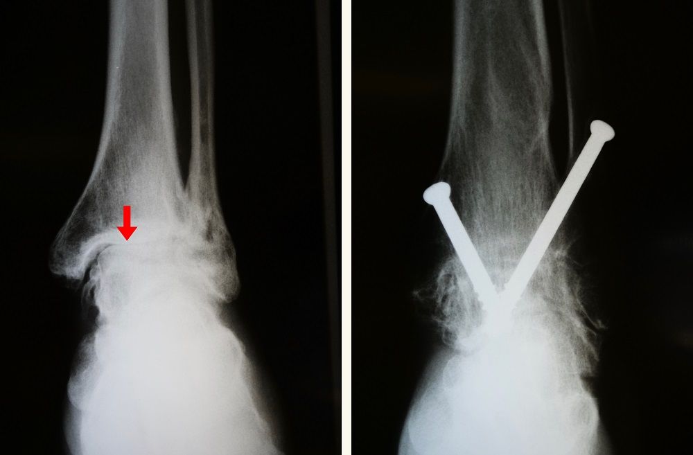 Arthritis of the Foot and Ankle - OrthoInfo - AAOS