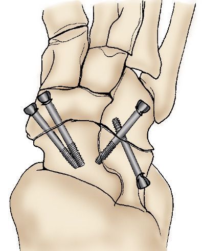 screws used in fusion of hindfoot