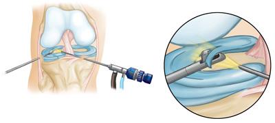 Trimming a torn meniscus