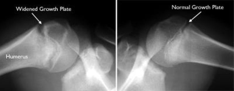 x-rays of normal and widened growth plates in shoulder