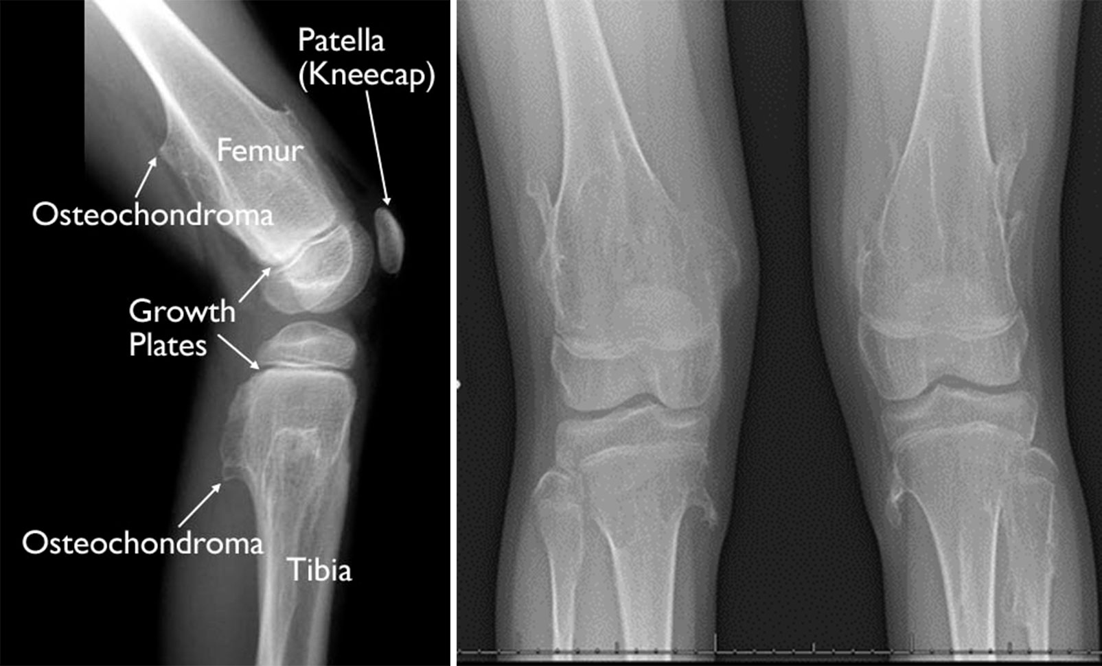 Multiple osteochondromas