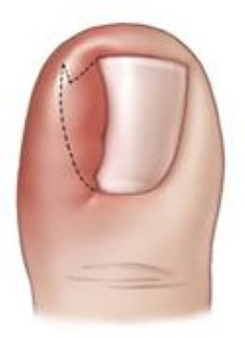 Ingrown Toenail - OrthoInfo - AAOS