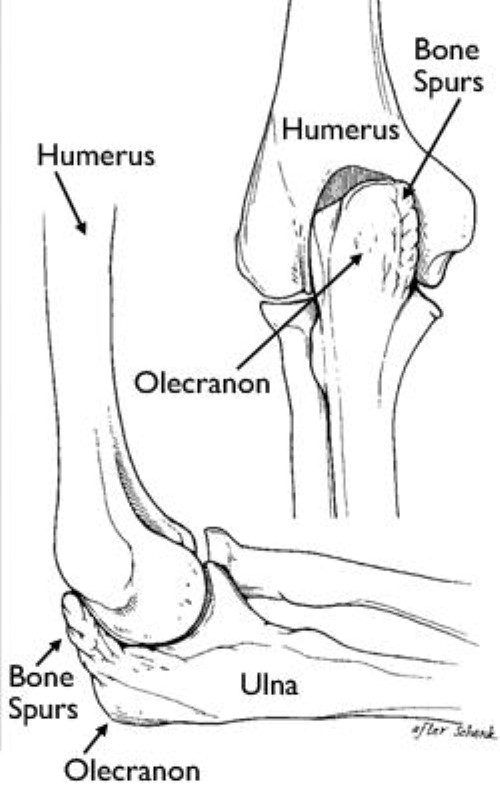 Elbow Dislocation - OrthoInfo - AAOS